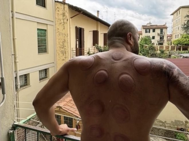 Round cupping marks on a client's back, seen from a balcony in Florence